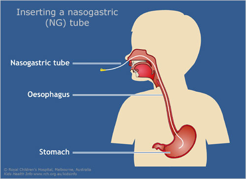 NasoGastric (NG) Feeding Tube Awareness Week - Love Dexter